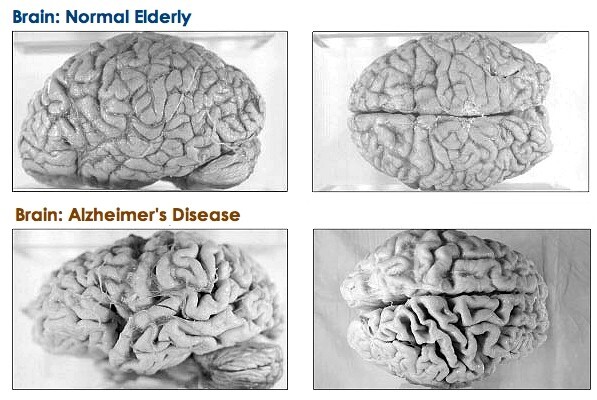 Hersenen Alzheimer