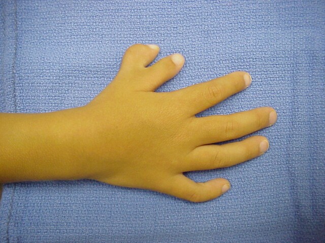zesde vinger