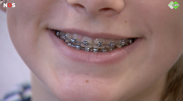 close up van mond met beugel